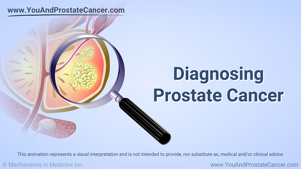 Animation - Diagnosing Prostate Cancer