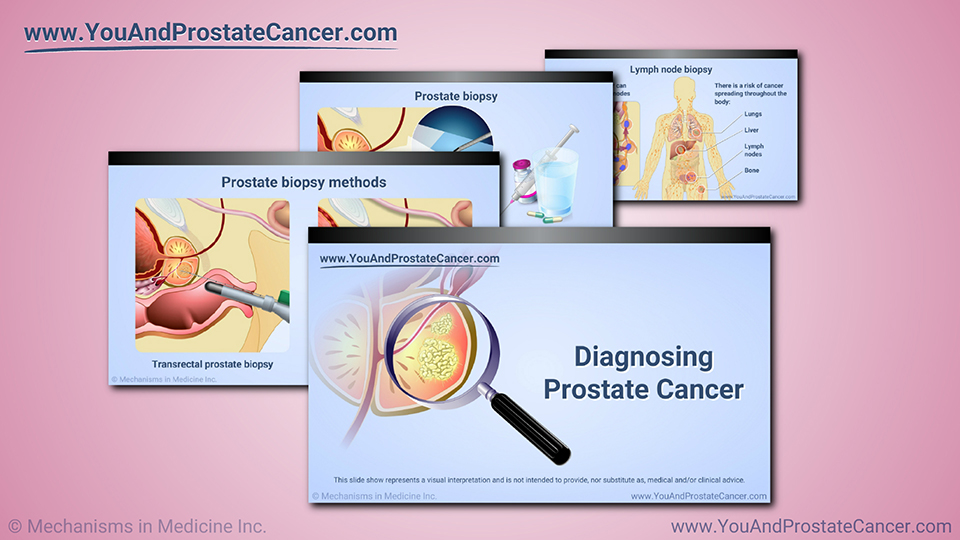 Slide Show - Diagnosing Prostate Cancer