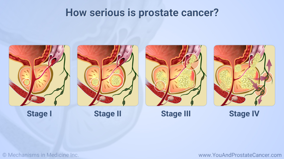 How serious is prostate cancer?