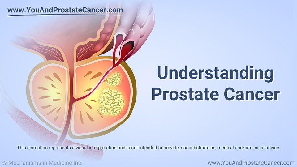 Animation - Understanding Prostate Cancer