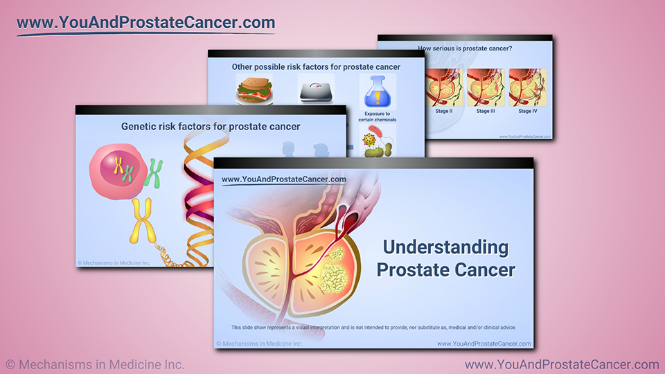 Slide Show - Understanding Prostate Cancer