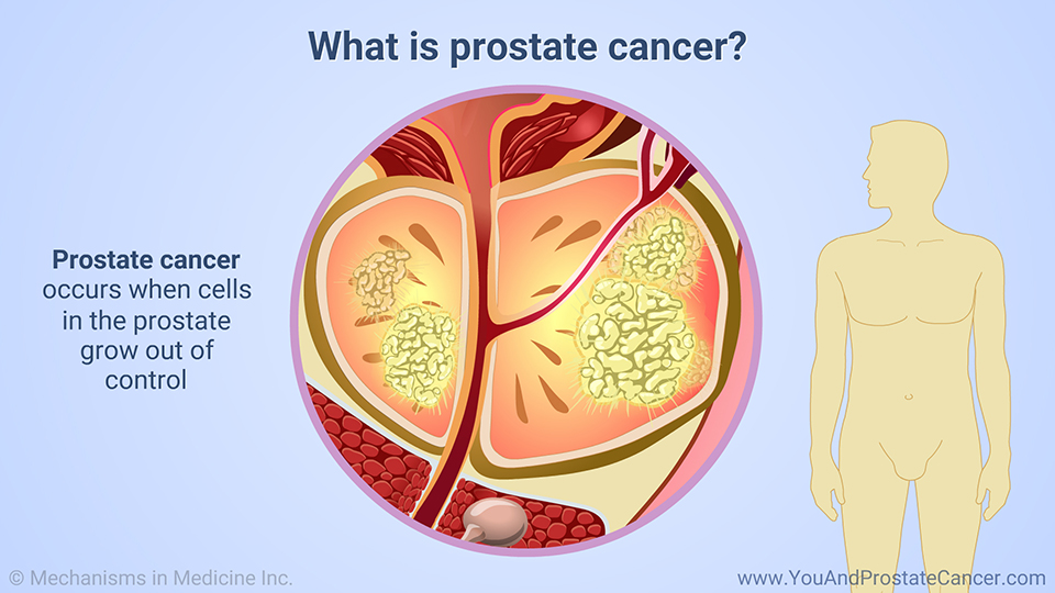 What is prostate cancer?