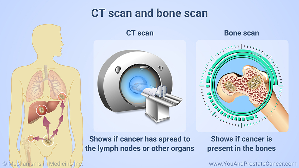 CT scan and bone scan