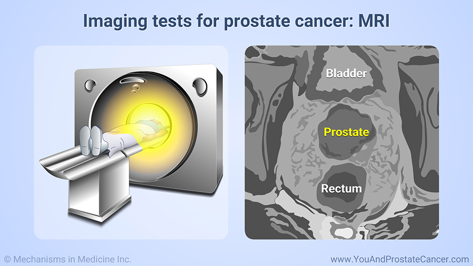 Imaging tests for prostate cancer: MRI