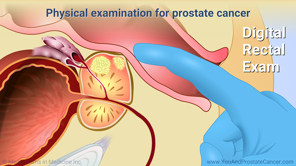 Physical examination for prostate cancer