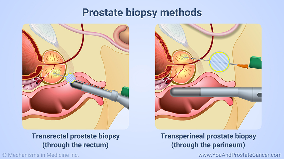 Prostate biopsy methods