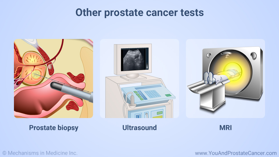 Other prostate cancer tests