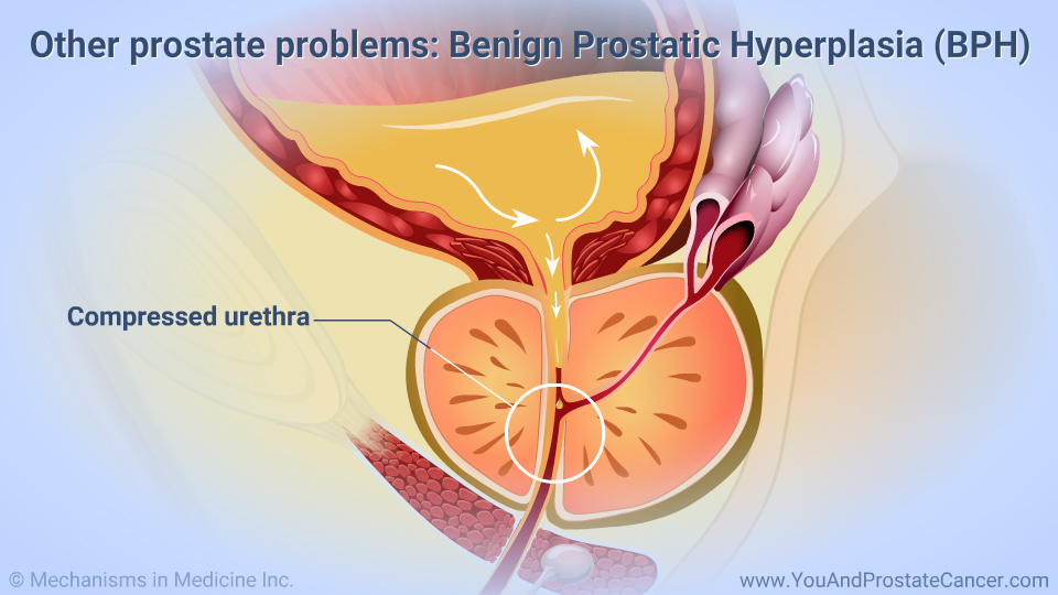 Other prostate problems: Benign Prostatic Hyperplasia (BPH)