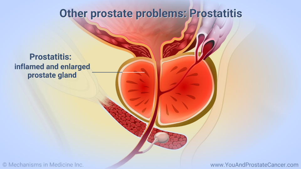 Other prostate problems: Prostatitis