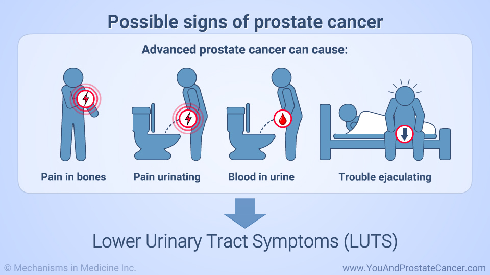 Possible signs of prostate cancer