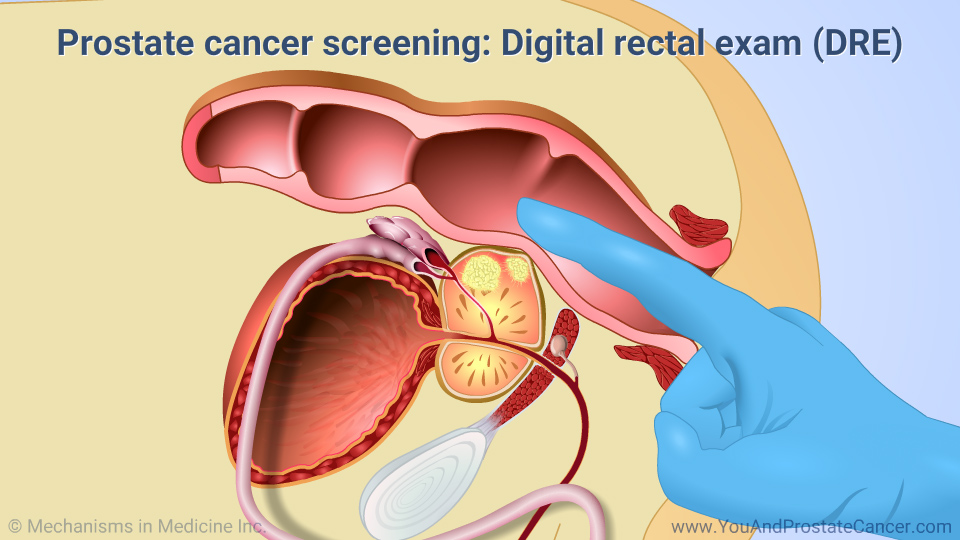 Prostate cancer screening: Digital rectal exam (DRE)
