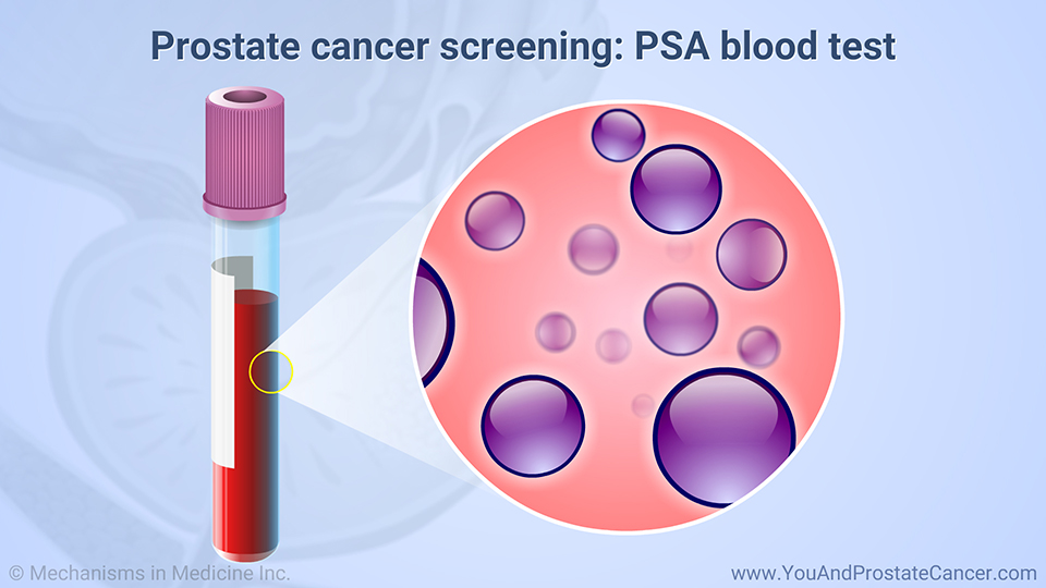 Prostate cancer screening: PSA blood test