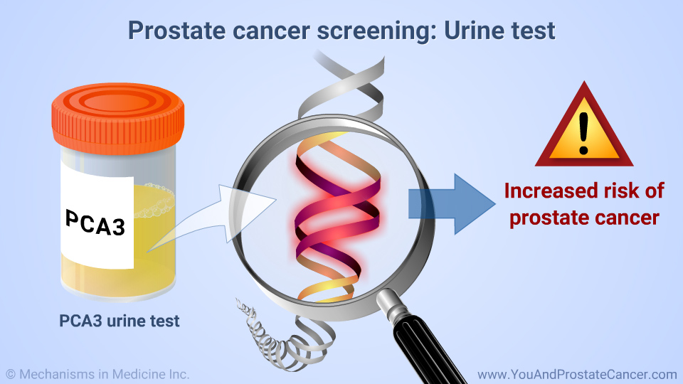 Prostate cancer screening: Urine test