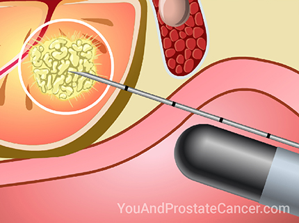 Learn about the tests commonly used to diagnose prostate cancer, and how prostate cancer is graded and staged.