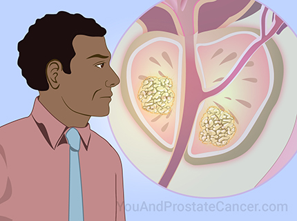 Black/African American men are at increased risk for prostate cancer. Watch to learn about risk factors, screening, and improving outcomes.